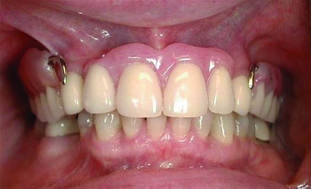 Upper And Lower Partial Dentures Brooklandville MD 21022